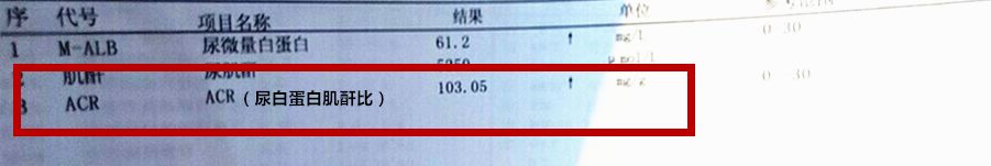 臨床目前最常用尿蛋白肌酐比來(lái)反應(yīng)尿微量白蛋白的水平